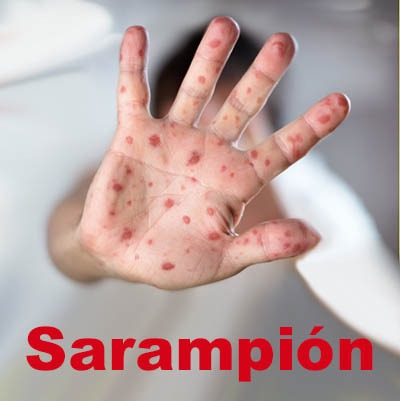 Ssa: existen 43 casos de sarampión en México, todos importados